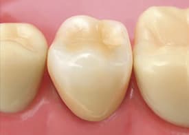 中目黒ゲートタウン歯科室の審美治療