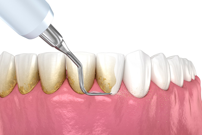 中目黒ゲートタウン歯科室の歯周病治療