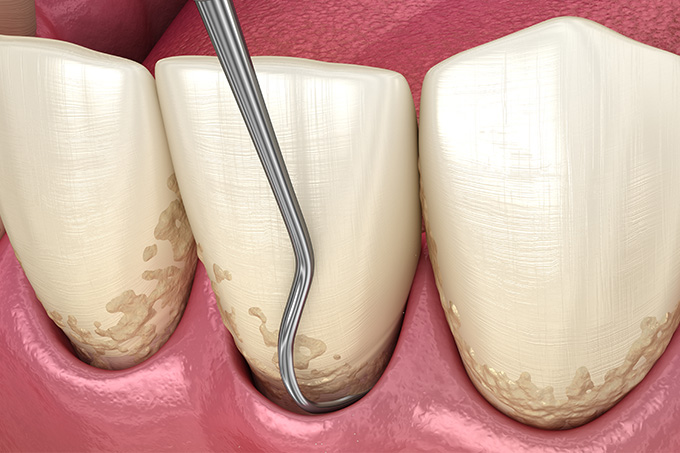 中目黒ゲートタウン歯科室の歯周病治療