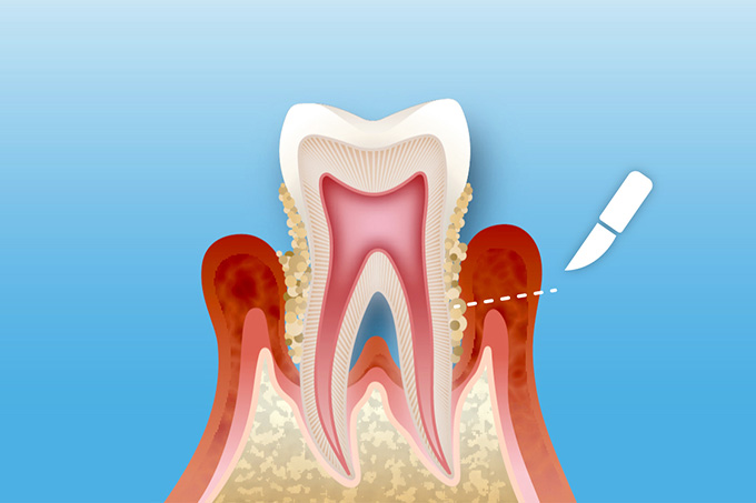 中目黒ゲートタウン歯科室の歯周病治療