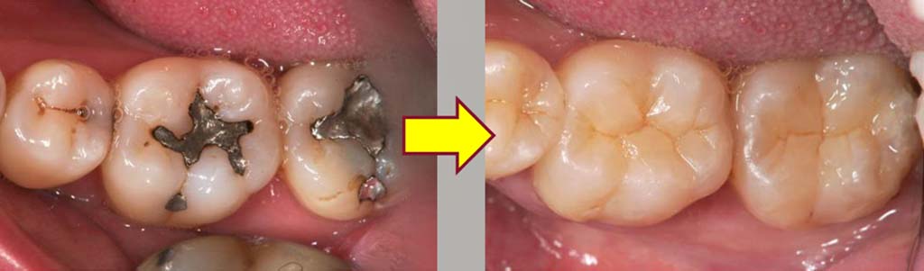 中目黒ゲートタウン歯科室のダイレクトボンディング