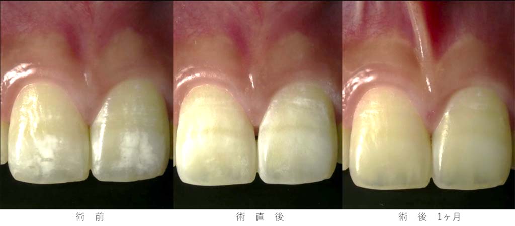 中目黒ゲートタウン歯科室のホワイトニング