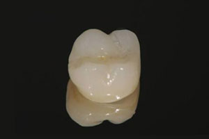 中目黒ゲートタウン歯科室の審美治療