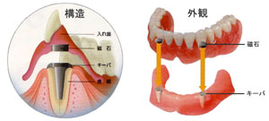 中目黒ゲートタウン歯科室の入れ歯治療