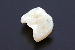 中目黒ゲートタウン歯科室の審美治療