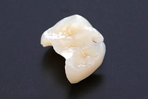 中目黒ゲートタウン歯科室の審美治療