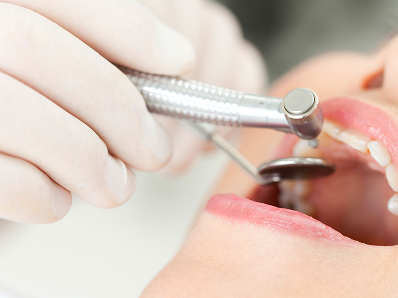 中目黒ゲートタウン歯科室のむし歯治療