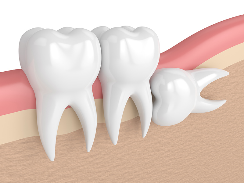 中目黒ゲートタウン歯科室の親知らずの抜歯