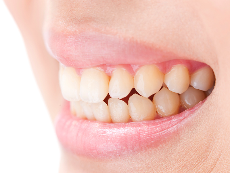 中目黒ゲートタウン歯科室の歯ぎしり・食いしばり治療