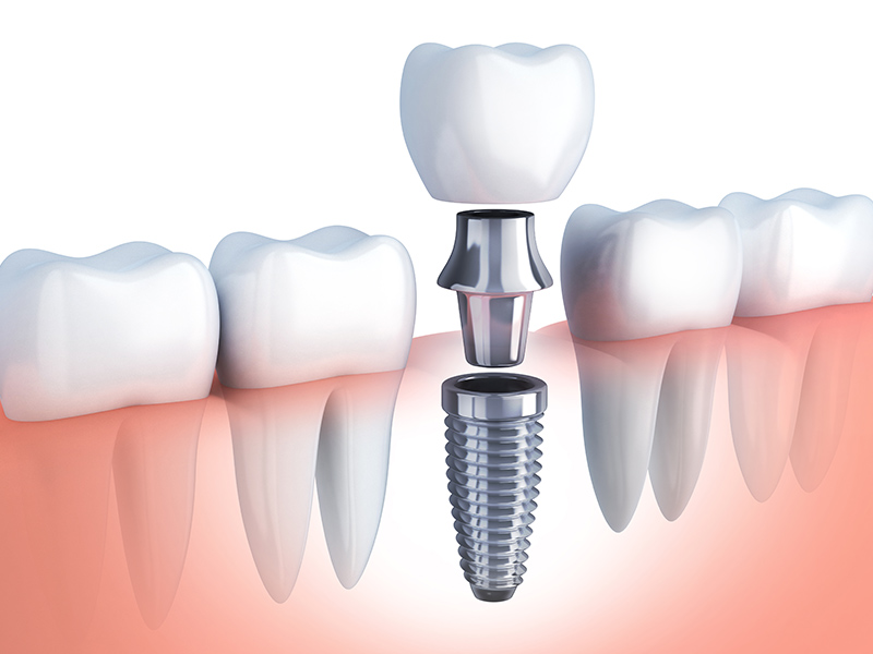 中目黒ゲートタウン歯科室のインプラント