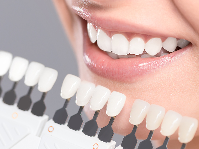 中目黒ゲートタウン歯科室のホワイトニング